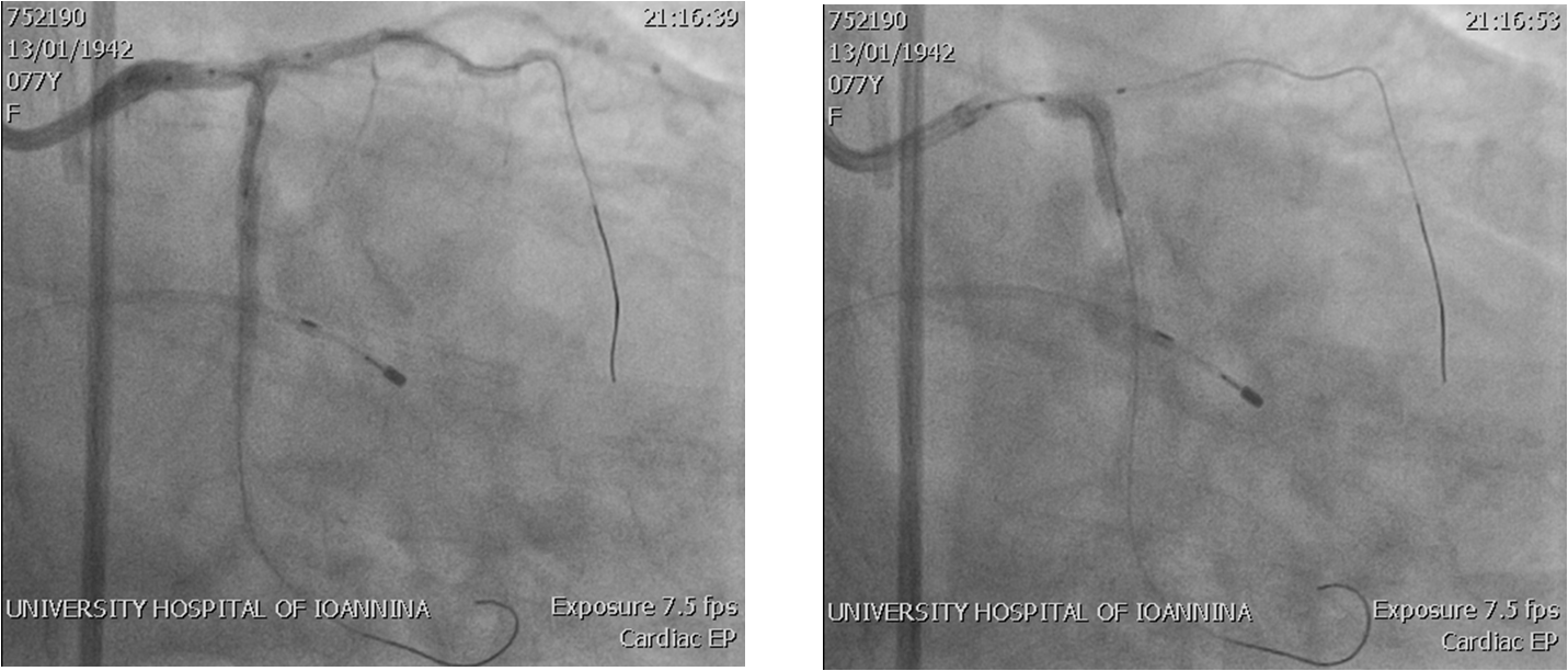 Image3 LM LCx stenting