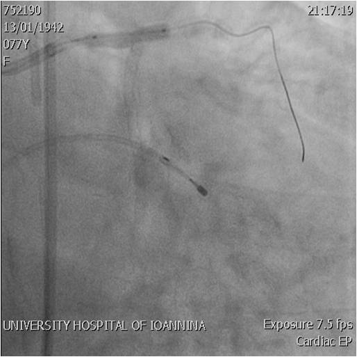 Image4 crush LM LCx stent
