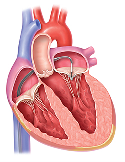 northwestern medicine heart illustration mitral valve